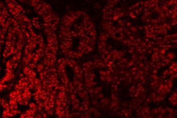 Immunofluorescent staining of FFPE human ovarian cancer tissue with SAP18 antibody. HIER: steam section in pH8 EDTA buffer for 20 min.