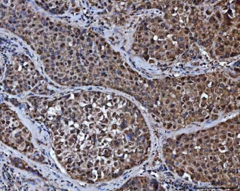 IHC staining of FFPE human liver cancer tissue with MRPP1 antibody. HIER: boil tissue sections in pH8 EDTA for 20 min and allow to cool before testing.