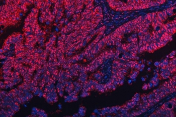 Immunofluorescent staining of FFPE human rectal cancer with MRPP1 antibody (red) and DAPI nuclear stain (blue). HIER: steam section in pH8 EDTA buffer for 20 min.