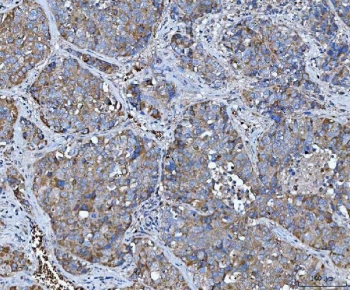 IHC staining of FFPE human liver cancer tissue with TRMT61B antibody. HIER: boil tissue sections in pH8 EDTA for 20 min and allow to cool before testing.