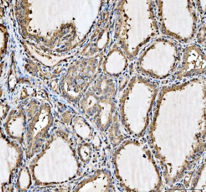 Hsp90 beta Antibody Human Thyroid Cancer IHC. Immunohistochemistry analysis of FFPE human thyroid cancer tissue using Hsp90 beta Antibody. Heat induced antigen retrieval was performed in pH 8.0 EDTA buffer prior to overnight incubation with primary antibody (2 ug/mL) at 4Â°C. Peroxidase-conjugated goat anti-mouse IgG and DAB chromogen were used for visualization. Predominantly cytoplasmic staining is observed in thyroid epithelial tumor cells, consistent with the intracellular localization of HSP90AB1 as a constitutively expressed molecular chaperone. These results support the use of Hsp90 beta Antibody for studying HSP90AB1, molecular chaperone function and cancer-associated protein homeostasis.