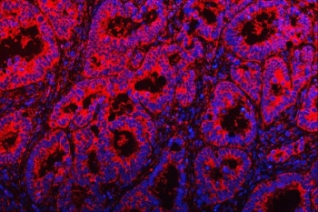 Immunofluorescent staining of FFPE human rectal cancer tissue with TOM1L1 antibody (red) and DAPI nuclear stain (blue). HIER: steam section in pH8 EDTA buffer for 20 min.