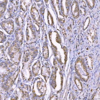 IHC staining of FFPE human prostate adenocarcinoma tissue with TOM1L1 antibody. HIER: boil tissue sections in pH8 EDTA for 20 min and allow to cool before testing.