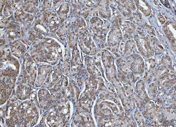 IHC staining of FFPE human prostate cancer tissue with TRIM16 antibody. HIER: boil tissue sections in pH8 EDTA for 20 min and allow to cool before testing.