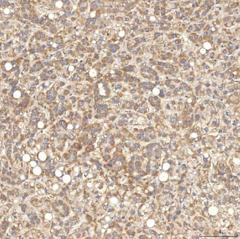 IHC staining of FFPE human liver cancer tissue with SGCE antibody. HIER: boil tissue sections in pH8 EDTA for 20 min and allow to cool before testing.