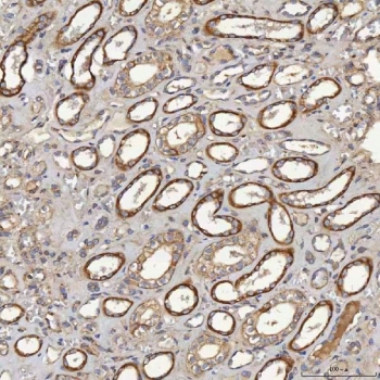 IHC staining of FFPE human renal cancer tissue with Acyl-CoA dehydrogenase family member 9 antibody. HIER: boil tissue sections in pH8 EDTA for 20 min and allow to cool before testing.