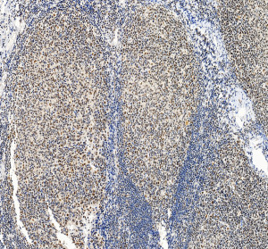 SMARCB1 Antibody by IHC Showing Tonsil Tissue Distribution Immunohistochemistry of FFPE human tonsil sections using SMARCB1 Antibody at 2 ug/ml. Widespread nuclear staining is evident throughout the tissue, with the lower-magnification view demonstrating the distribution of SMARCB1/INI1-positive cells across the tonsillar architecture. This INI1 Polyclonal Antibody was tested following heat-induced epitope retrieval in EDTA buffer.