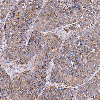 IHC staining of FFPE human liver cancer tissue with SERAC1 antibody. HIER: boil tissue sections in pH8 EDTA for 20 min and allow to cool before testing.