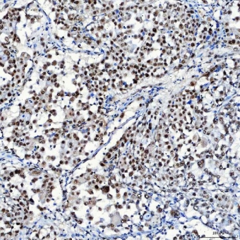 IHC staining of FFPE human lung adenocarcinoma tissue with SF3a120 antibody. HIER: boil tissue sections in pH8 EDTA for 20 min and allow to cool before testing.