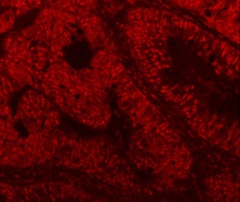 Immunofluorescent staining of FFPE human intestinal cancer tissue with SF3a60 antibody. HIER: steam section in pH8 EDTA buffer for 20 min.