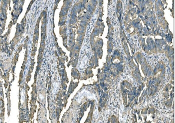 IHC staining of FFPE human rectum adenocarcinoma cancer tissue with GOT1 antibody. HIER: boil tissue sections in pH8 EDTA for 20 min and allow to cool before testing.