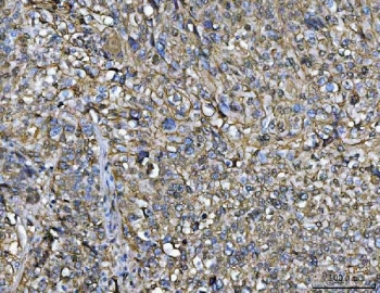 IHC staining of FFPE human lung squamous cell carcinoma tissue with ANXA1 antibody. HIER: boil tissue sections in pH8 EDTA for 20 min and allow to cool before testing.