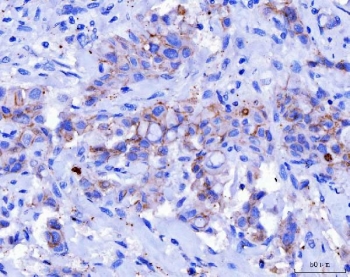 Desmoglein 2 Antibody Breast Cancer IHC. Immunohistochemistry analysis of FFPE human breast cancer tissue stained with DSG2 antibody detecting Desmoglein 2. Tumor epithelial cells show membranous and cytoplasmic staining with focal accentuation at cell-cell borders, consistent with DSG2 localization in desmosomal adhesion complexes that maintain epithelial cohesion. Surrounding stromal elements display minimal staining. Hematoxylin counterstain highlights nuclei in blue. HIER: boil tissue sections in pH 8 EDTA for 20 min and allow to cool before testing.