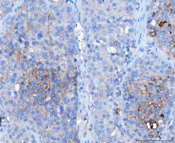 Desmoglein 2 Antibody Hepatocellular Carcinoma IHC. Immunohistochemistry analysis of FFPE human hepatocellular carcinoma tissue stained with DSG2 antibody detecting Desmoglein 2. Tumor cells show membranous and cytoplasmic staining with focal accentuation at cell-cell borders, consistent with DSG2 localization in desmosomal adhesion complexes that support intercellular adhesion. Staining appears heterogeneous across tumor regions, while adjacent non-tumor areas show reduced signal. Hematoxylin counterstain highlights nuclei in blue. HIER: boil tissue sections in pH 8 EDTA for 20 min and allow to cool before testing.