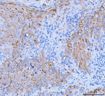 Desmoglein 2 Antibody Laryngeal Squamous Cell Carcinoma IHC. Immunohistochemistry analysis of FFPE human laryngeal squamous cell carcinoma tissue stained with DSG2 antibody detecting Desmoglein 2. Tumor epithelial cells show membranous and cytoplasmic staining with prominent accentuation at cell-cell borders, consistent with DSG2 localization in desmosomal adhesion complexes that maintain epithelial cohesion. The staining highlights squamous tumor cell clusters, while surrounding stromal regions show reduced signal. Hematoxylin counterstain highlights nuclei in blue. HIER: boil tissue sections in pH 8 EDTA for 20 min and allow to cool before testing.