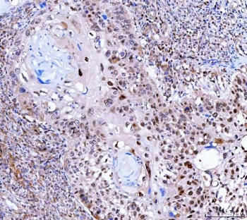 IHC staining of FFPE human laryngeal squamous cell carcinoma tissue with FAM60A antibody. HIER: boil tissue sections in pH8 EDTA for 20 min and allow to cool before testing.