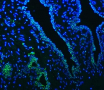 SLC22A8 / OAT3 Antibody Prostate Cancer IF. Immunofluorescence staining of FFPE human prostate cancer tissue using SLC22A8 Antibody / Organic Anion Transporter 3 (OAT3) Antibody demonstrates distinct green fluorescence within subsets of epithelial tumor-associated cells, consistent with expression of the membrane transporter SLC22A8/OAT3. Signal is observed in discrete cellular populations against a background of DAPI-counterstained nuclei (blue), supporting evaluation of transporter expression and localization in human prostate cancer tissue. Heat-induced epitope retrieval was performed by steaming tissue sections in pH 8 EDTA buffer for 20 minutes prior to staining. Target protein is visualized in green and nuclei are shown in blue.