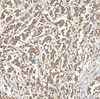 SLC22A8 / OAT3 Antibody Breast Cancer IHC. Immunohistochemistry staining of FFPE human breast cancer tissue using SLC22A8 Antibody / Organic Anion Transporter 3 (OAT3) Antibody demonstrates moderate to strong HRP-DAB brown staining within malignant epithelial cell populations. The observed staining pattern is predominantly membranous and cytoplasmic, consistent with expression of SLC22A8/OAT3, a transmembrane organic anion transporter involved in cellular uptake and transport of endogenous metabolites and xenobiotic compounds. These results support evaluation of OAT3 expression and localization in human breast cancer tissue. Heat-induced epitope retrieval was performed by boiling tissue sections in pH 8 EDTA buffer for 20 minutes followed by cooling prior to staining.