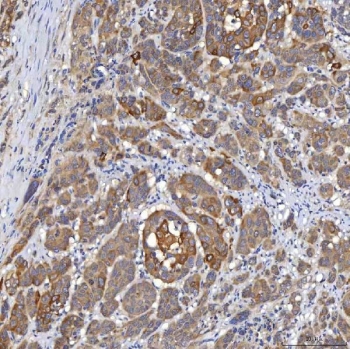 SLC22A8 / OAT3 Antibody Prostate Adenocarcinoma IHC. Immunohistochemistry staining of FFPE human prostate adenocarcinoma tissue using SLC22A8 Antibody / Organic Anion Transporter 3 (OAT3) Antibody demonstrates moderate to strong HRP-DAB brown staining within malignant glandular epithelial cells. The observed staining pattern is predominantly membranous and cytoplasmic, consistent with expression of SLC22A8/OAT3, a transmembrane transporter involved in organic anion uptake and cellular transport of endogenous metabolites and xenobiotic compounds. Staining highlights neoplastic glandular structures within the tumor microenvironment and supports evaluation of OAT3 expression and localization in human prostate adenocarcinoma tissue. Heat-induced epitope retrieval was performed by boiling tissue sections in pH 8 EDTA buffer for 20 minutes followed by cooling prior to staining.