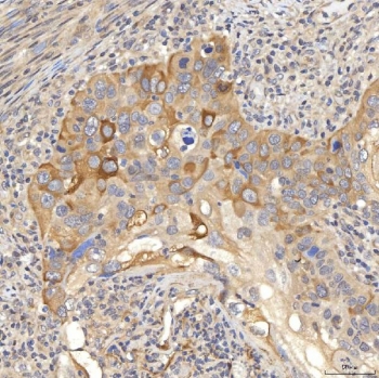 SLC22A8 / OAT3 Antibody Larynx Squamous Cell Carcinoma IHC. Immunohistochemistry staining of FFPE human larynx squamous cell carcinoma tissue using SLC22A8 Antibody / Organic Anion Transporter 3 (OAT3) Antibody demonstrates moderate to strong HRP-DAB brown staining within malignant squamous epithelial cell populations. The observed staining pattern is predominantly membranous and cytoplasmic, consistent with expression of SLC22A8/OAT3, a transmembrane organic anion transporter involved in cellular uptake and transport of endogenous metabolites, signaling molecules, and xenobiotic compounds. Staining highlights tumor-associated epithelial nests and supports evaluation of OAT3 expression and localization in human laryngeal squamous cell carcinoma tissue. Heat-induced epitope retrieval was performed by boiling tissue sections in pH 8 EDTA buffer for 20 minutes followed by cooling prior to staining.
