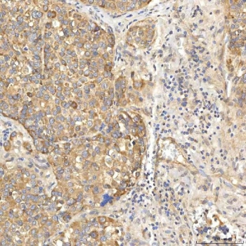 SLC22A8 / OAT3 Antibody Liver Cancer IHC. Immunohistochemistry staining of FFPE human liver cancer tissue using SLC22A8 Antibody / Organic Anion Transporter 3 (OAT3) Antibody demonstrates moderate to strong HRP-DAB brown staining within malignant hepatocyte-like tumor cell populations. The observed staining pattern is predominantly membranous and cytoplasmic, consistent with expression of SLC22A8/OAT3, a transporter involved in organic anion uptake and cellular handling of endogenous metabolites, drugs, and xenobiotic compounds. Staining highlights tumor-associated epithelial cells and supports evaluation of OAT3 expression and localization in human liver cancer tissue. Heat-induced epitope retrieval was performed by boiling tissue sections in pH 8 EDTA buffer for 20 minutes followed by cooling prior to staining.