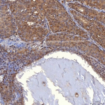 IHC staining of FFPE human breast cancer tissue with PIG3 antibody. HIER: boil tissue sections in pH8 EDTA for 20 min and allow to cool before testing.