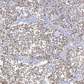Immunohistochemistry analysis of TRMT61A / tRNA methyltransferase 61A antibody in human lung adenocarcinoma tissue. Formalin-fixed, paraffin-embedded human lung adenocarcinoma tissue was stained using TRMT61A / tRNA methyltransferase 61A antibody. Heat-induced epitope retrieval was performed by boiling tissue sections in EDTA buffer, pH 8.0, for 20 minutes, followed by cooling prior to antibody incubation. Brown chromogenic signal is observed predominantly in the nuclei and cytoplasm of tumor epithelial cells forming glandular structures, while surrounding stromal regions show comparatively reduced staining. This staining pattern reflects cellular expression of TRMT61A in lung adenocarcinoma tissue.