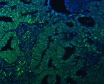 Immunofluorescent staining of FFPE human ovarian cancer tissue with TRMT61A/tRNA methyltransferase 61A antibody (green) and DAPI nuclear stain (blue). HIER: steam section in pH8 EDTA buffer for 20 min.