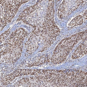 IHC staining of FFPE human larynx squamous cell carcinoma tissue with TRMT61A/tRNA methyltransferase 61A antibody. HIER: boil tissue sections in pH8 EDTA for 20 min and allow to cool before testing.