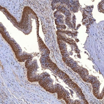 IHC staining of FFPE human colon adenocarcinoma tissue with TRMT61A/tRNA methyltransferase 61A antibody. HIER: boil tissue sections in pH8 EDTA for 20 min and allow to cool before testing.