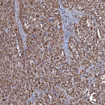 IHC staining of FFPE human ovarian serous cancer tissue with TRMT61A/tRNA methyltransferase 61A antibody. HIER: boil tissue sections in pH8 EDTA for 20 min and allow to cool before testing.