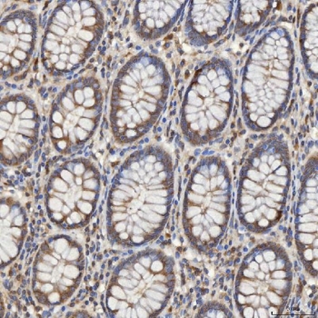IHC staining of FFPE human colon adenocarcinoma tissue with SLC25A10 antibody. HIER: boil tissue sections in pH8 EDTA for 20 min and allow to cool before testing.