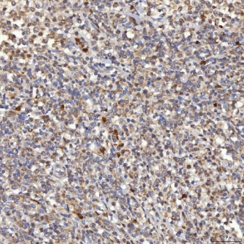 IHC staining of FFPE human diffuse large B cell lymphoma tissue with SLC25A10 antibody. HIER: boil tissue sections in pH8 EDTA for 20 min and allow to cool before testing.
