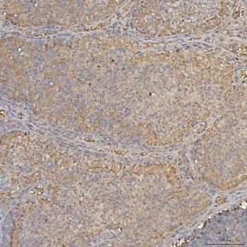 IHC staining of FFPE human endometrioid adenocarcinoma tissue with SLC25A24 antibody. HIER: boil tissue sections in pH8 EDTA for 20 min and allow to cool before testing.