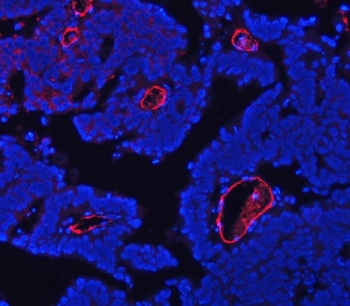 CD105 Antibody Ovarian Cancer Tissue IF. Immunofluorescence analysis of FFPE human ovarian cancer tissue using CD105 Antibody (red) demonstrates strong membranous staining of endothelial cells lining tumor-associated vasculature, consistent with Endoglin / CD105 expression as an endothelial marker of angiogenic blood vessels, while nuclei are counterstained with DAPI (blue). HIER: steam tissue sections in EDTA buffer, pH 8.0, for 20 min prior to immunostaining.