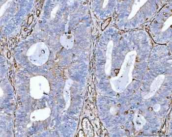 CD105 Antibody Endometrial Adenocarcinoma IHC. Immunohistochemistry analysis of FFPE human endometrial adenocarcinoma tissue using CD105 Antibody demonstrates HRP-DAB brown membranous staining of endothelial cells outlining tumor-associated vasculature within the stromal compartments, consistent with Endoglin / CD105 expression as an endothelial marker of angiogenic blood vessels, while tumor epithelial cells show minimal staining; nuclei are counterstained blue. HIER: boil tissue sections in pH 8 EDTA for 20 min and allow to cool before testing.