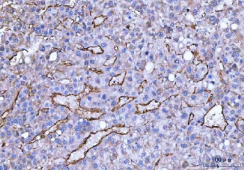 CD105 Antibody Liver Cancer IHC. Immunohistochemistry analysis of FFPE human liver cancer tissue using CD105 Antibody demonstrates HRP-DAB brown membranous staining of endothelial cells outlining irregular tumor-associated vasculature within the hepatic tumor parenchyma, consistent with Endoglin / CD105 expression as an endothelial marker of angiogenic blood vessels, while surrounding tumor cells show minimal staining; nuclei are counterstained blue. HIER: boil tissue sections in pH 8 EDTA for 20 min and allow to cool before testing.