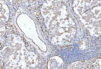 CD105 Antibody Lung Cancer IHC. Immunohistochemistry analysis of FFPE human lung cancer tissue using CD105 Antibody demonstrates HRP-DAB brown membranous staining of endothelial cells lining tumor-associated vasculature within stromal regions, consistent with Endoglin / CD105 expression as an endothelial marker of angiogenic blood vessels, while tumor epithelial cells show minimal staining; nuclei are counterstained blue. HIER: boil tissue sections in pH 8 EDTA for 20 min and allow to cool before testing.