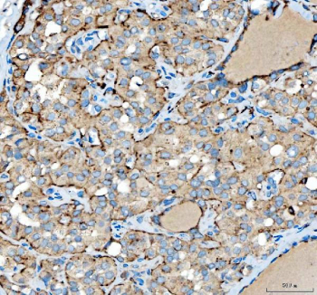 IHC staining of FFPE human thyroid papillary carcinoma tissue with SIAE antibody. HIER: boil tissue sections in pH8 EDTA for 20 min and allow to cool before testing.