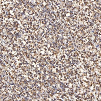 IHC staining of FFPE human diffuse large B-cell lymphoma tissue with Thiosulfate sulfurtransferase antibody. HIER: boil tissue sections in pH8 EDTA for 20 min and allow to cool before testing.
