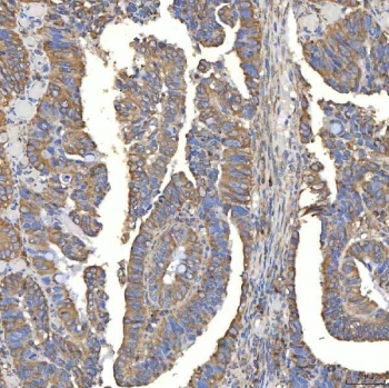 IHC staining of FFPE human rectum adenocarcinoma tissue with TXNDC5 antibody. HIER: boil tissue sections in pH8 EDTA for 20 min and allow to cool before testing.