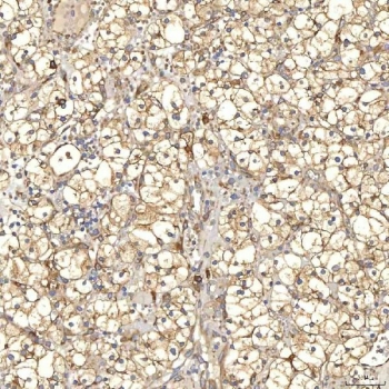 IHC staining of FFPE human renal cancer tissue with TXNDC5 antibody. HIER: boil tissue sections in pH8 EDTA for 20 min and allow to cool before testing.