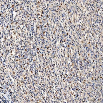 IHC staining of FFPE human diffuse large B cell lymphoma tissue with PAO-1 antibody. HIER: boil tissue sections in pH8 EDTA for 20 min and allow to cool before testing.