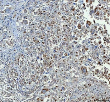 CHGA Antibody Lung Adenocarcinoma IHC. Immunohistochemistry staining of FFPE human lung adenocarcinoma tissue with CHGA antibody. HIER: boil tissue sections in pH8 EDTA for 20 min and allow to cool before testing.