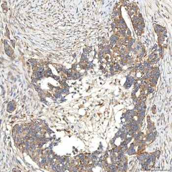 IHC staining of FFPE human ovarian serous adenocarcinoma tissue with Syntaphilin antibody. HIER: boil tissue sections in pH8 EDTA for 20 min and allow to cool before testing.