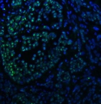 Immunofluorescent staining of FFPE human breast cancer tissue with SNRNP40 antibody (green) and DAPI nuclear stain (blue). HIER: steam section in pH8 EDTA buffer for 20 min.