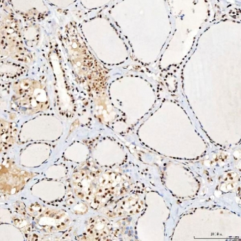 IHC staining of FFPE human thyroid papillary carcinoma tissue with SNRNP40 antibody. HIER: boil tissue sections in pH8 EDTA for 20 min and allow to cool before testing.