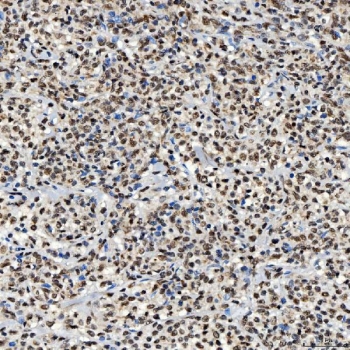 IHC staining of FFPE human diffuse large B cell lymphoma tissue with SNRNP40 antibody. HIER: boil tissue sections in pH8 EDTA for 20 min and allow to cool before testing.