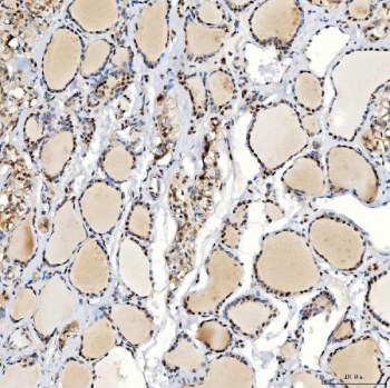 IHC staining of FFPE human thyroid papillary carcinoma tissue with U1 snRNP C antibody. HIER: boil tissue sections in pH8 EDTA for 20 min and allow to cool before testing.