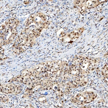IHC staining of FFPE human appendix adenocarcinoma tissue with U1 snRNP C antibody. HIER: boil tissue sections in pH8 EDTA for 20 min and allow to cool before testing.
